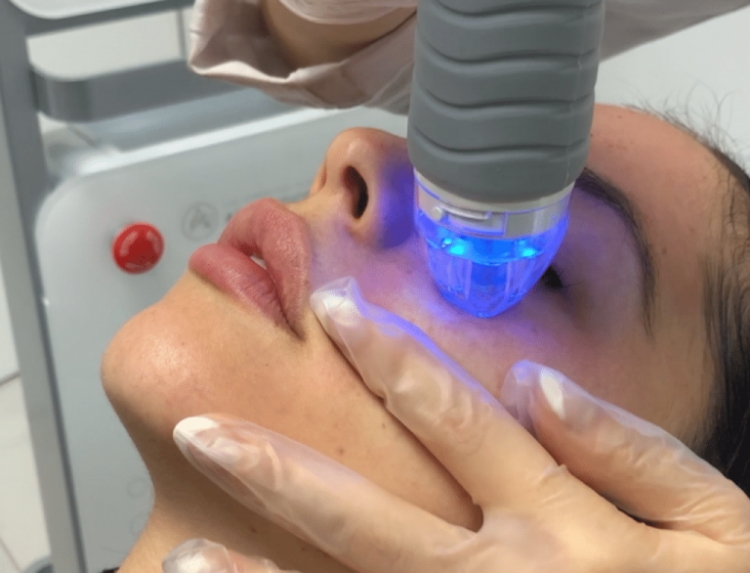 About Sincoheren: Leader in Microneedling and Peeling Technologies