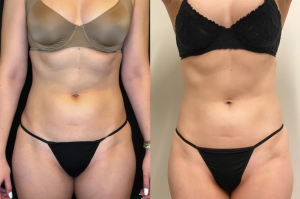 emsculpt body sculpting