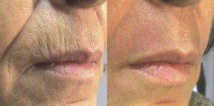 co2 laser for skin tightening