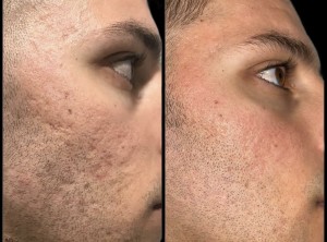 co2 laser for acne scars